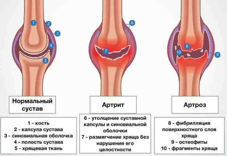 Развитие заболеваний суставов, переход артрита в артроз